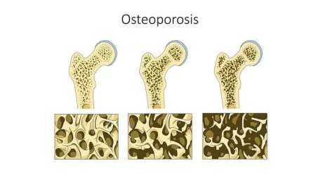 1024px Osteoporosis wm SA 980x551.jpg