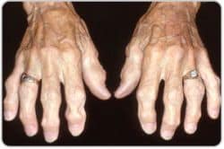 Degenerative Arthritis